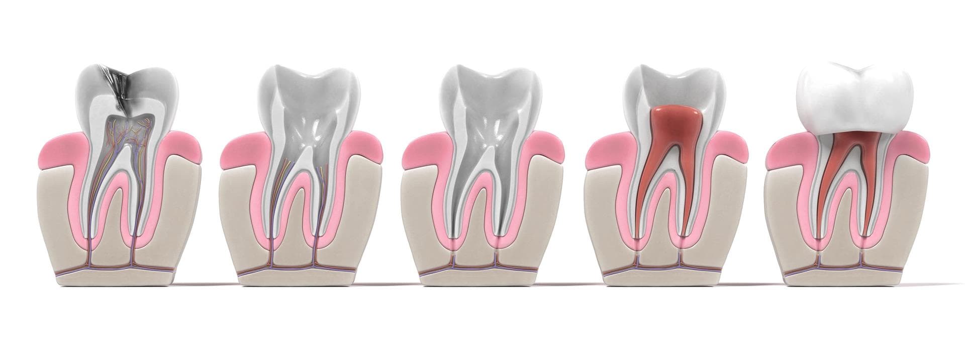 Endodoncia