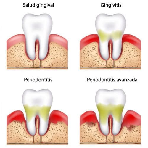 Periodoncia