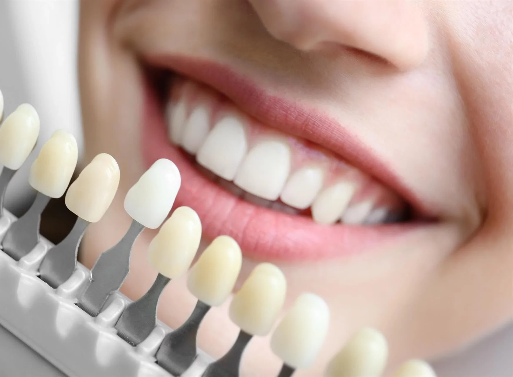 carillas en Clínica Dental Carballiño
